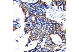 Immunohistochemistry of paraffin-embedded Human colon carcinoma using ESPN Rabbit pAb (ABIN7267008) at dilution of 1:100 (40x lens). (Espin antibody  (AA 585-854))