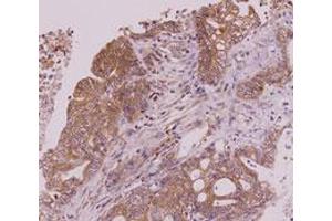 Immunohistochemistry paraffin embedded sections of human colorectal cancer tissue were incubated with monoclonal CLEC4E monoclonal antibody, clone AT16E3  (1 : 50) for 2 hours at room temperature. (CLEC4E antibody  (AA 41-219))