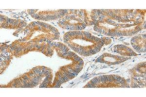 Immunohistochemistry of paraffin-embedded Human colon cancer tissue using SLC12A4 Polyclonal Antibody at dilution 1:30