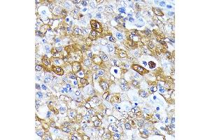 Immunohistochemistry of paraffin-embedded human esophageal cancer using  antibody  at dilution of 1:100 (40x lens). (ATG7 antibody)