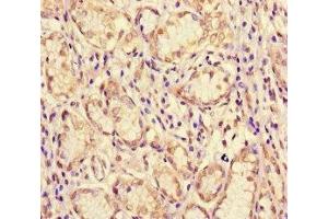 Immunohistochemistry of paraffin-embedded human gastric cancer using ABIN7160996 at dilution of 1:100 (ME1 antibody  (AA 161-519))