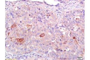 Formalin-fixed and paraffin embedded human lung carcinoma labeled with Anti-CNR2/CB2 Polyclonal Antibody, Unconjugated  at 1:200 followed by conjugation to the secondary antibody and DAB staining. (CNR2 antibody  (AA 251-350))