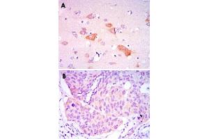 Immunohistochemical analysis of paraffin-embedded human brain tissue (A) and lung cancer tissue (B) using SMAD5 monoclonal antobody, clone 3H9  with DAB staining.