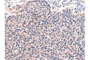 The image on the left is immunohistochemistry of paraffin-embedded Human lung cancer tissue using ABIN7190092(CCL7 Antibody) at dilution 1/20, on the right is treated with synthetic peptide. (CCL7 antibody)