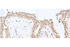 Immunohistochemistry of paraffin-embedded Human breast cancer tissue using KDM2B Polyclonal Antibody at dilution of 1:50(x200) (KDM2B antibody)