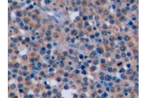 Detection of CD7 in Human Lymphoma Tissue using Polyclonal Antibody to Cluster Of Differentiation 7 (CD7) (CD7 antibody  (AA 26-134))