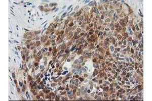 Immunohistochemical staining of paraffin-embedded Adenocarcinoma of Human breast tissue using anti-OSBP mouse monoclonal antibody.
