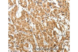 Immunohistochemistry of Human thyroid cancer using MAP1A Polyclonal Antibody at dilution of 1:40
