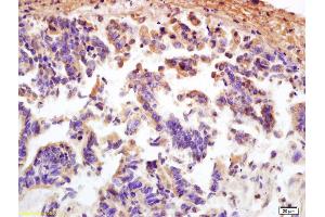 Formalin-fixed and paraffin embedded human rectal carcinoma labeled with Anti MCP1/CCL2 Polyclonal Antibody (ABIN675863), Unconjugated at 1:200, followed by conjugation to the secondary antibody and DAB staining