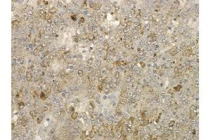 ABIN6259072 and ABIN6273576 at 1/100 staining human melanoma by IHC-P.