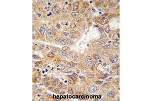 Formalin-fixed and paraffin-embedded human hepatocarcinomareacted with PGK1 polyclonal antibody , which was peroxidase-conjugated to the secondary antibody, followed by AEC staining. (PGK1 antibody  (Internal Region))