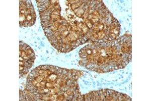 IHC testing of FFPE human colon carcinoma with MAML3 antibody (clone MMLP3-1). (MAML3 antibody)