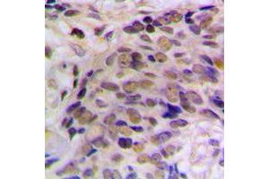Immunohistochemical analysis of HES6 staining in human prostate cancer formalin fixed paraffin embedded tissue section. (HES6 antibody  (N-Term))