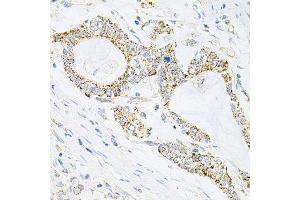 Immunohistochemistry of paraffin-embedded human gastric cancer using IRS1 antibody at dilution of 1:100 (x40 lens). (IRS1 antibody)