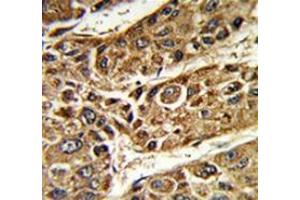 Immunohistochemistry analysis of human hepatocarcinoma (Formalin-fixed, Paraffin-embedded) using MTTP Antibody (C-term), followed by peroxidase-conjugated secondary antibody and DAB staining. (MTTP antibody  (C-Term))