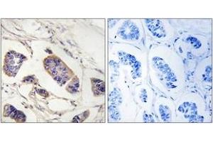 Immunohistochemistry analysis of paraffin-embedded human breast carcinoma tissue, using PEX7 Antibody. (PEX7 antibody  (AA 204-253))
