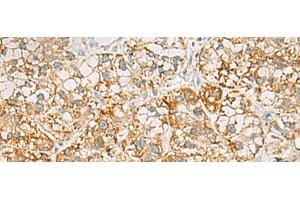 Immunohistochemistry of paraffin-embedded Human liver cancer tissue using SH3YL1 Polyclonal Antibody at dilution of 1:55(x200) (SH3YL1 antibody)