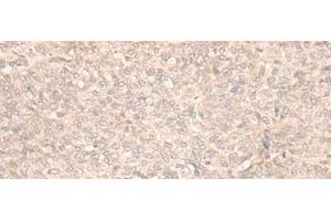 Immunohistochemistry of paraffin-embedded Human ovarian cancer tissue using FAN1 Polyclonal Antibody at dilution of 1:30(x200) (FAN1 antibody)