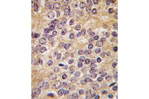 Formalin-fixed and paraffin-embedded human prostata carcinoma tissue reacted with PLAU antibody (C-term ), which was peroxidase-conjugated to the secondary antibody, followed by DAB staining. (PLAU antibody  (C-Term))