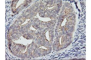 Immunohistochemical staining of paraffin-embedded Adenocarcinoma of Human endometrium tissue using anti-RTN4IP1 mouse monoclonal antibody. (RTN4IP1 antibody  (AA 41-279))