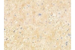 ABIN6263839 and ABIN6272700 at 1/100 staining human astrocytoma by IHC-P.