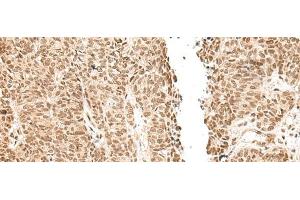 Immunohistochemistry of paraffin-embedded Human ovarian cancer tissue using LGALS4 Polyclonal Antibody at dilution of 1:30(x200) (GAL4 antibody)