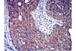 Immunohistochemical analysis of paraffin-embedded cervical cancer tissues using P2RY8 mouse mAb with DAB staining. (P2RY8 antibody)