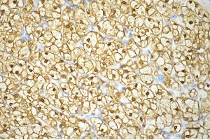 Immunohistochemistry was performed on paraffin-embedded human renal carcinoma using enolase 1 antibody (ABIN7798448), 1:200). (Recombinant ENO1 antibody)