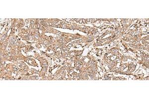 Immunohistochemistry of paraffin-embedded Human liver cancer tissue using FAAP24 Polyclonal Antibody at dilution of 1:30(x200) (FAAP24 antibody)