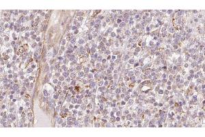 ABIN6273208 at 1/100 staining Human lymph cancer tissue by IHC-P. (CHCHD4 antibody  (N-Term))