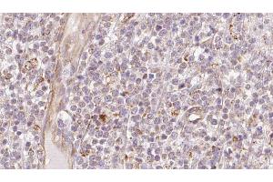 ABIN6273208 at 1/100 staining Human lymph cancer tissue by IHC-P.