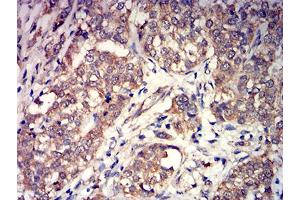 Immunohistochemical analysis of paraffin-embedded bladder cancer tissues using GRM3 mouse mAb with DAB staining. (Metabotropic Glutamate Receptor 3 antibody  (AA 433-576))