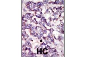 Formalin-fixed and paraffin-embedded human cancer tissue reacted with the primary antibody, which was peroxidase-conjugated to the secondary antibody, followed by DAB staining. (PDK2 antibody  (C-Term))