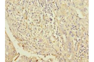Immunohistochemistry of paraffin-embedded human lung cancer using ABIN7163118 at dilution of 1:100 (Lipin 1 antibody  (AA 741-890))