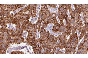 ABIN6267144 at 1/100 staining Human thyroid cancer tissue by IHC-P.