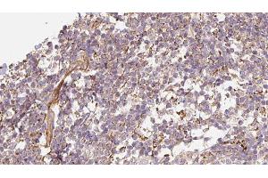 ABIN6276608 at 1/100 staining Human Melanoma tissue by IHC-P. (DEFB121 antibody  (Internal Region))