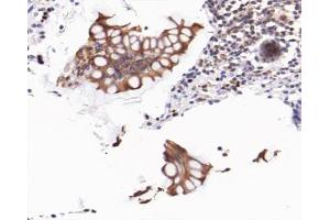 ABIN6267477 at 1/200 staining human colon cancer tissue sections by IHC-P. (CTNNB1 antibody  (pSer37))