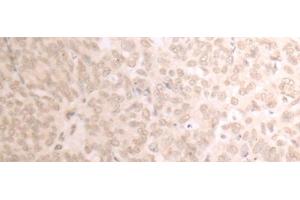 Immunohistochemistry of paraffin-embedded Human ovarian cancer tissue using TRMT1 Polyclonal Antibody at dilution of 1:25(x200) (TRMT1 antibody)