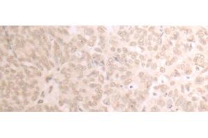 Immunohistochemistry of paraffin-embedded Human ovarian cancer tissue using TRMT1 Polyclonal Antibody at dilution of 1:25(x200) (TRMT1 antibody)
