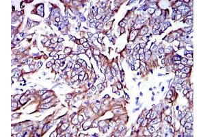 Immunohistochemical analysis of paraffin-embedded human stomach cancer tissues using KRT19 mouse mAb with DAB staining. (Cytokeratin 19 antibody)