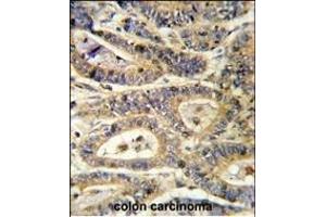 Formalin-fixed and paraffin-embedded human colon carcinoma reacted with IGFBP6 Antibody (C-term), which was peroxidase-conjugated to the secondary antibody, followed by DAB staining.