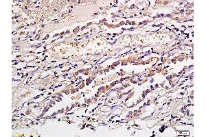 Formalin-fixed and paraffin embedded human gastric cancer labeled with Anti CD1a/Cortical thymocyte antigen CD1A Polyclonal Antibody, Unconjugated (ABIN704096) at 1:300 followed by conjugation to the secondary antibody and DAB staining (CD1a antibody  (AA 151-250))
