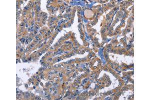 Immunohistochemistry of Human thyroid cancer using PRKCD Polyclonal Antibody at dilution of 1:30 (PKC delta antibody)