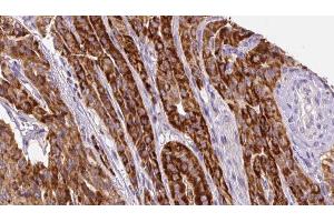 ABIN6267133 at 1/100 staining Human thyroid cancer tissue by IHC-P. (LAT antibody  (pTyr200))