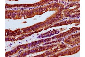 IHC image of ABIN7174418 diluted at 1:300 and staining in paraffin-embedded human colon cancer performed on a Leica BondTM system. (UBAC2 antibody  (AA 1-157))
