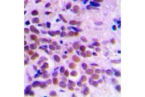 Immunohistochemical analysis of CDC2 staining in human breast cancer formalin fixed paraffin embedded tissue section. (CDK1 antibody  (Center))