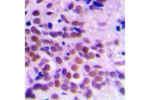 Immunohistochemical analysis of CDC2 staining in human breast cancer formalin fixed paraffin embedded tissue section. (CDK1 antibody  (Center))