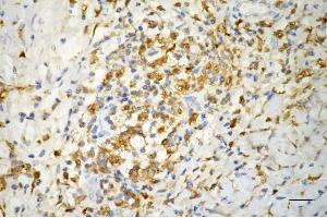 Immunohistochemistry was performed on paraffin-embedded human pancreatic adenocarcinoma using ferritin light chain antibody (ABIN7798597), 1:200).
