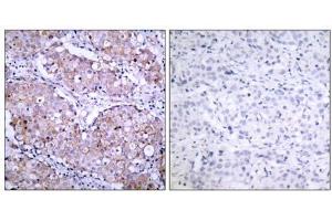 Immunohistochemical analysis of paraffin- embedded human breast carcinoma tissue, using (EGFR antibody  (pSer1070))
