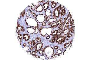 Prostatic adenocarcinoma Gleason 336 with strong AGR2 staining of all tumor cells